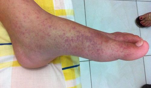 2012-01-09_Chikungunya_on_the_left_feet_at_The_Philippines.jpeg-500x373