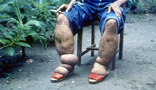 Filariasis2